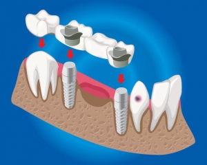 How Do Dental Implants Enhance Your Appearance?